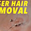 Science of Laser Hair Removal in SLOW MOTION